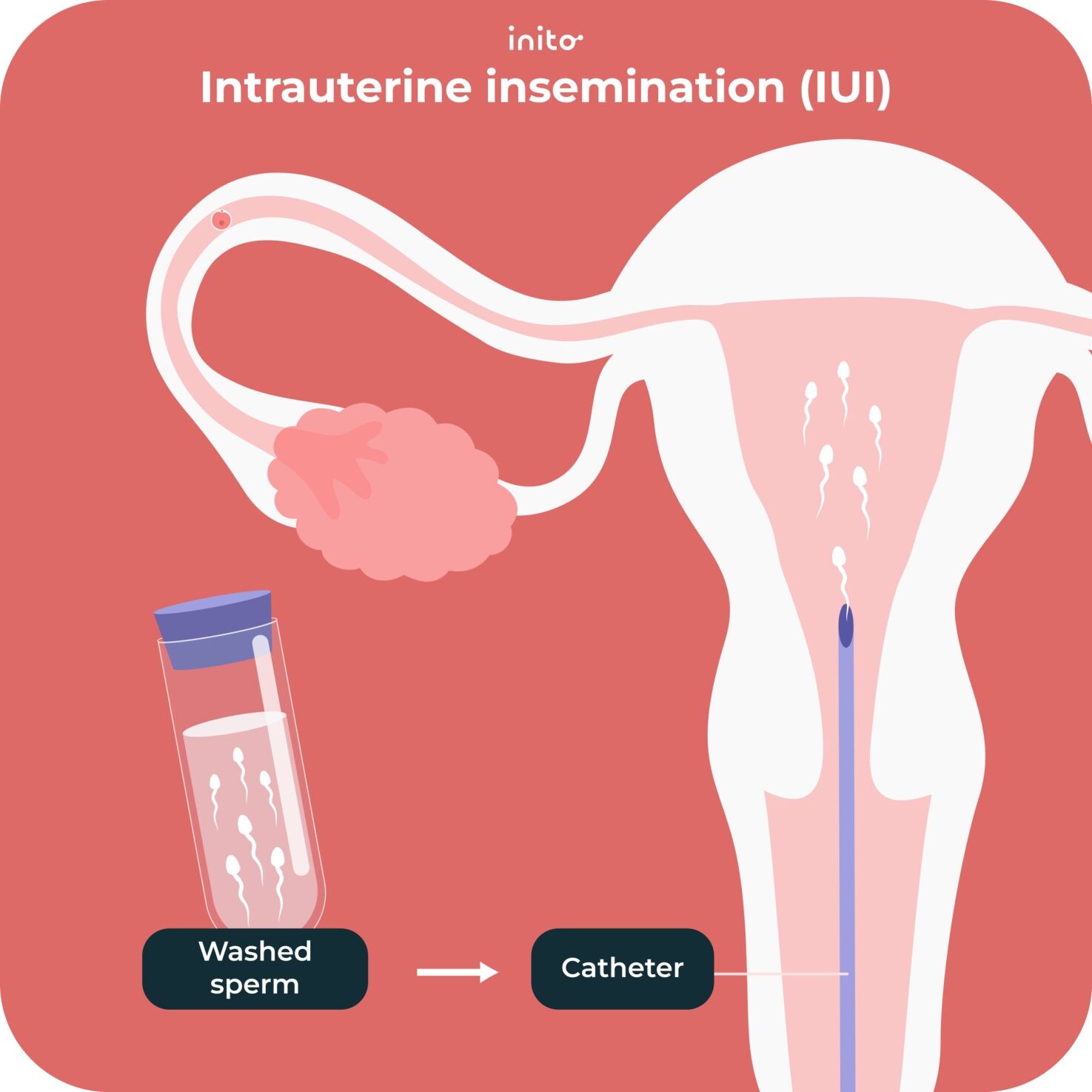 Intrauterine insemination (IUI)