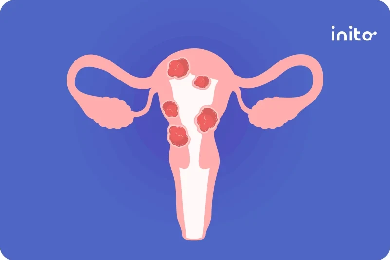 Can You Get Pregnant With A Fibroid?