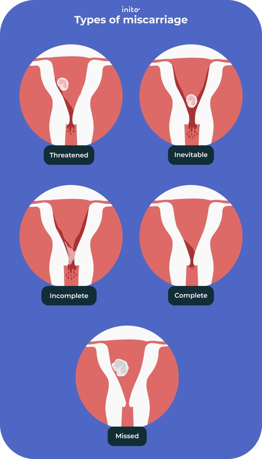 Types of miscarriages