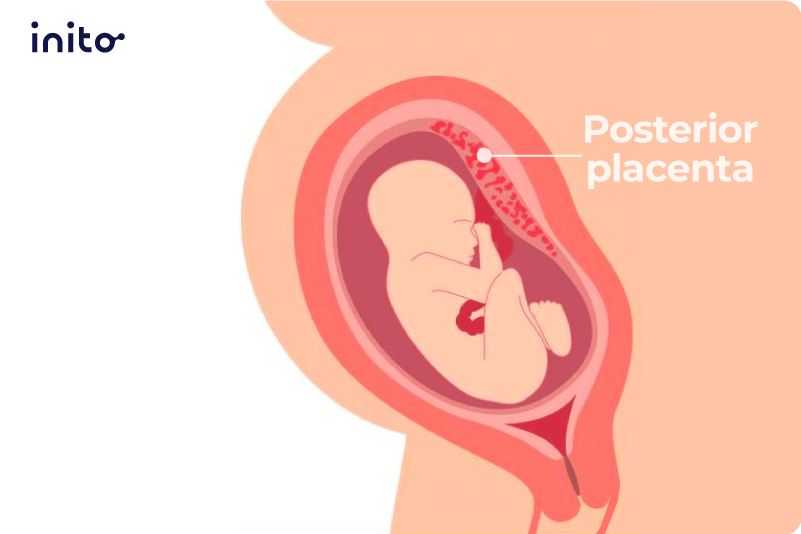 Posterior placenta