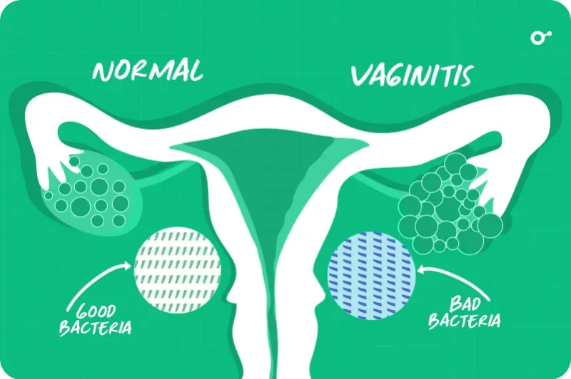 Bacterial Vaginosis