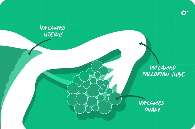 Pelvic Inflammatory Disease