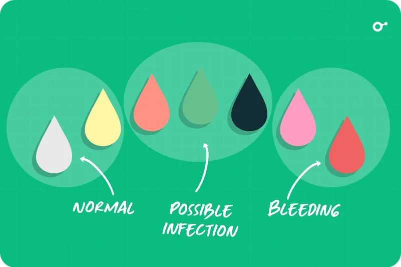 What normal discharge looks like
