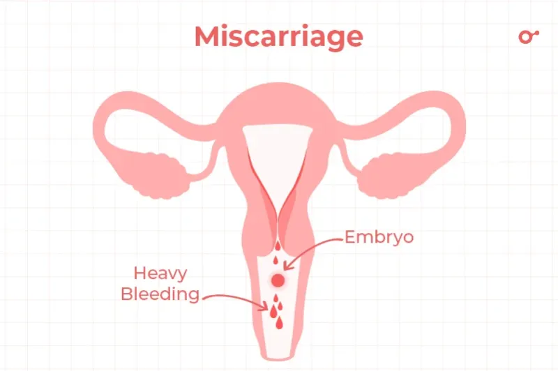 Miscarriage