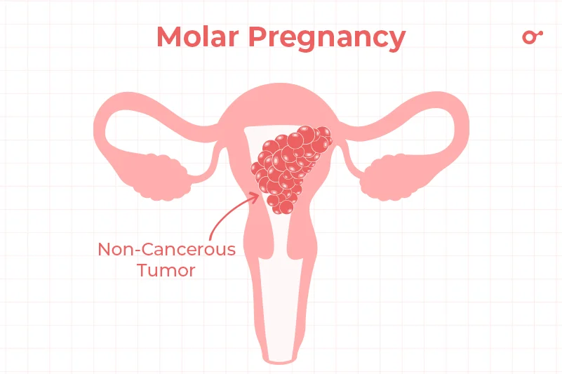 Molar pregnancy