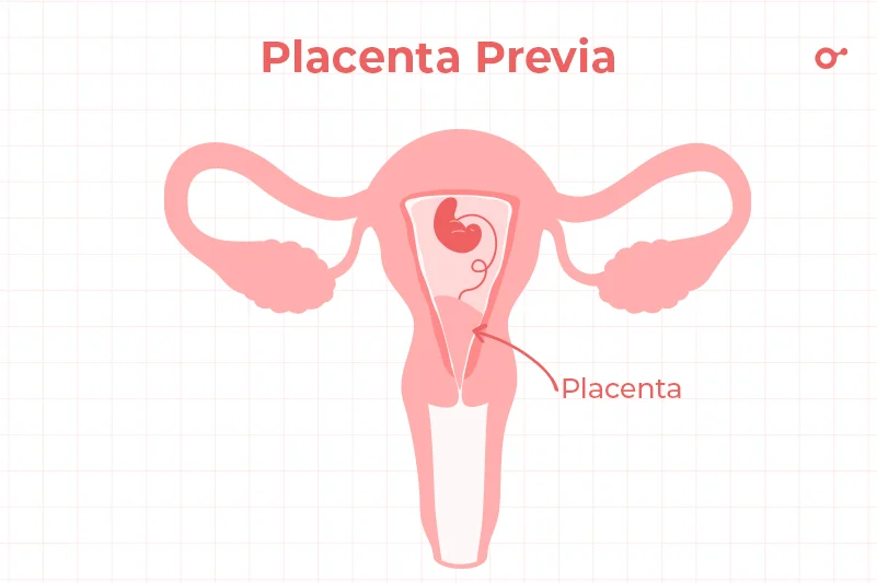 Placenta previa