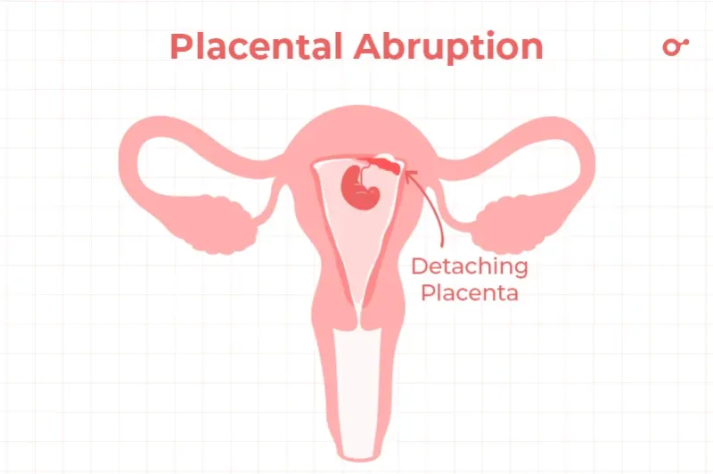 Placental abruption
