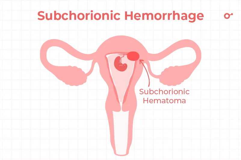 Subchorionic hemorrhage