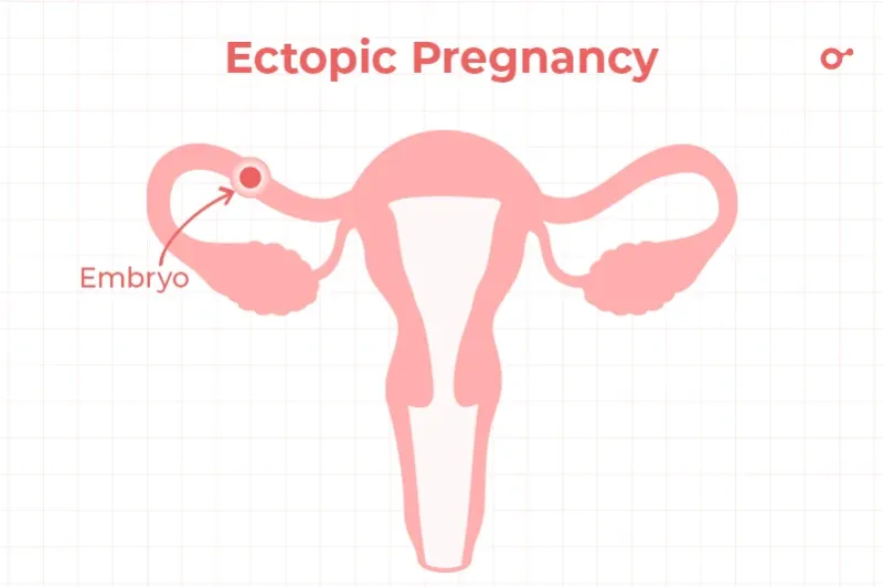ectopic pregnancy