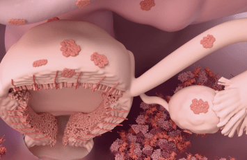 3 Uncommon Symptoms of Endometriosis Hidden Clues