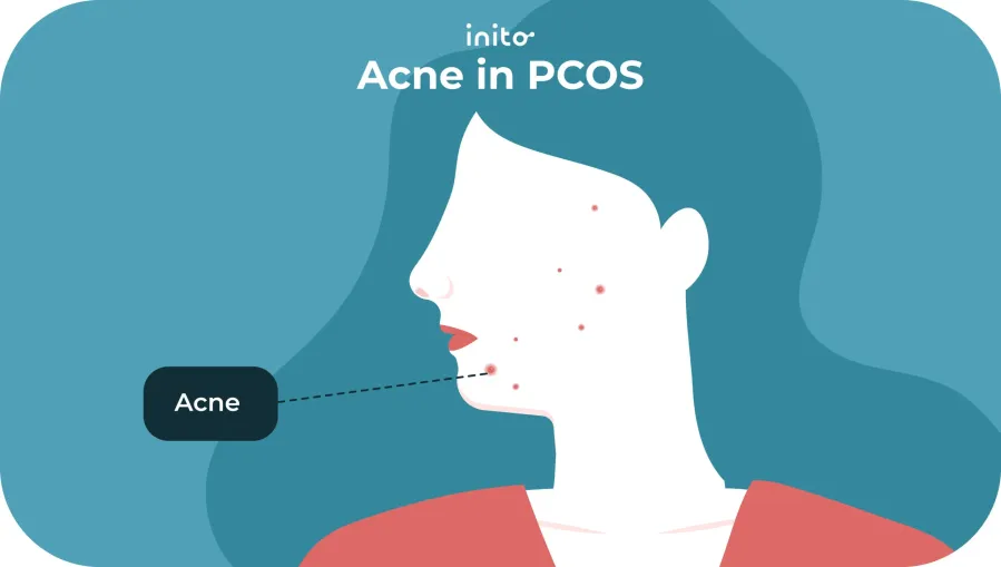 Spironolactone for PCOS: Benefits and Fertility Tip 6 Acne in pcos