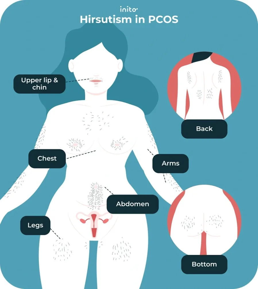 Spironolactone for PCOS: Benefits and Fertility Tip 5 Hirsutism in PCOS