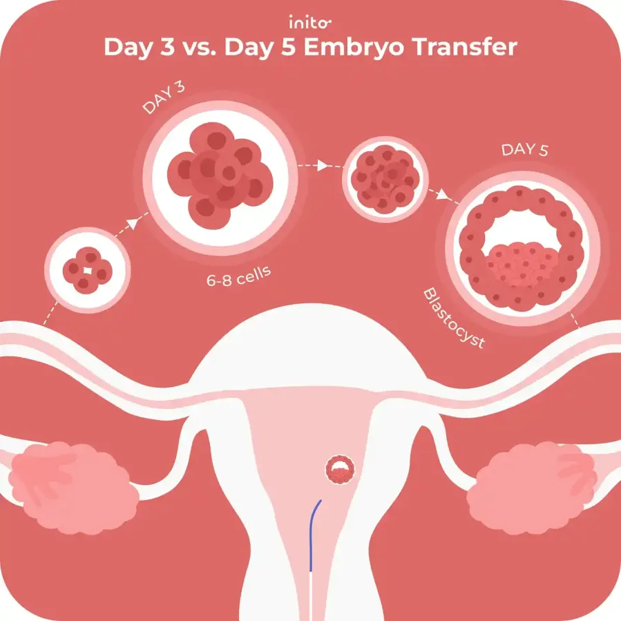Day 3 vs. Day 5 Embryo Transfer Day 3 vs. Day 5 Embryo Transfer
