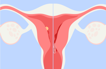 30 Implantation bleeding vs. Miscarriage bleeding Know the difference