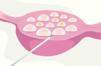 Egg Retrieval Process