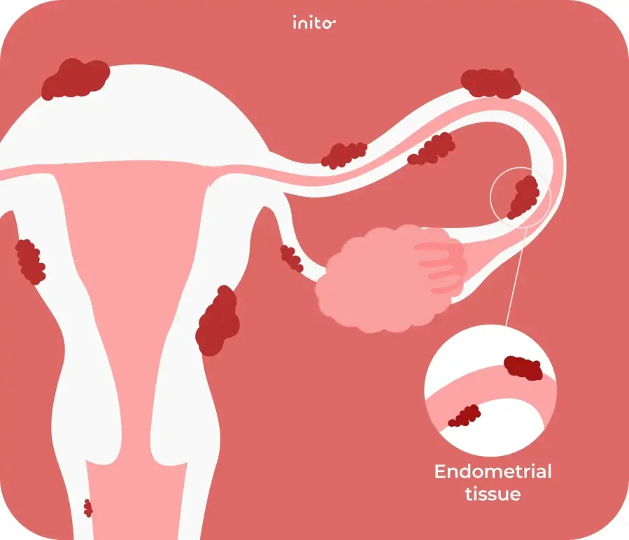 What is endometriosis