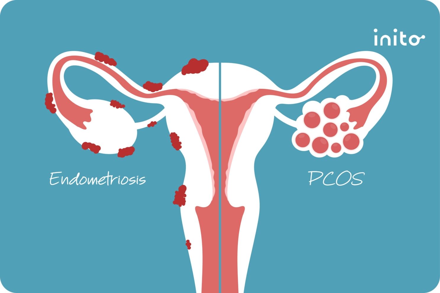 Endometriosis vs. PCOS